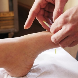 acupuncture-